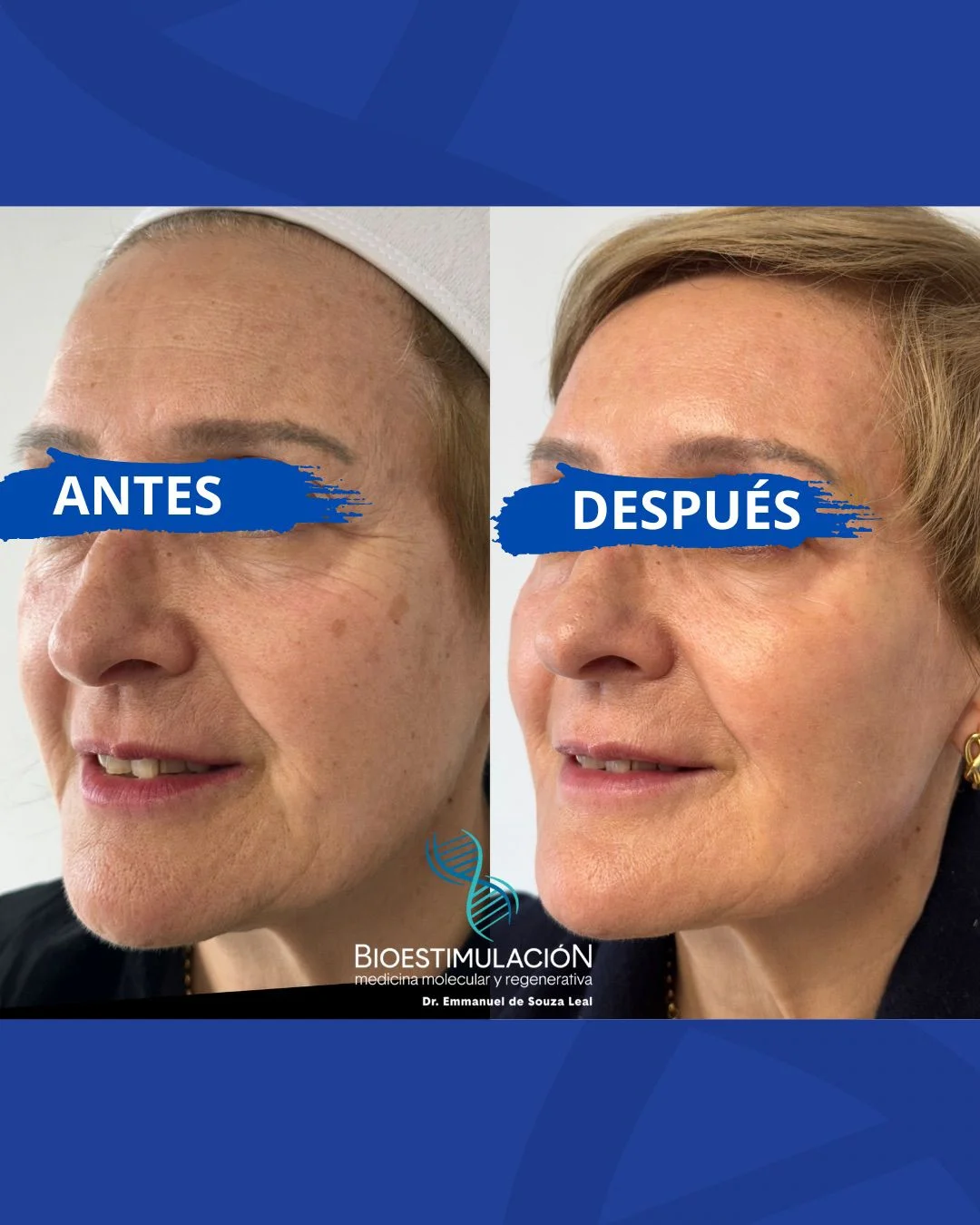 Resultado de tratamiento facial en Montevideo – Bioestimulación